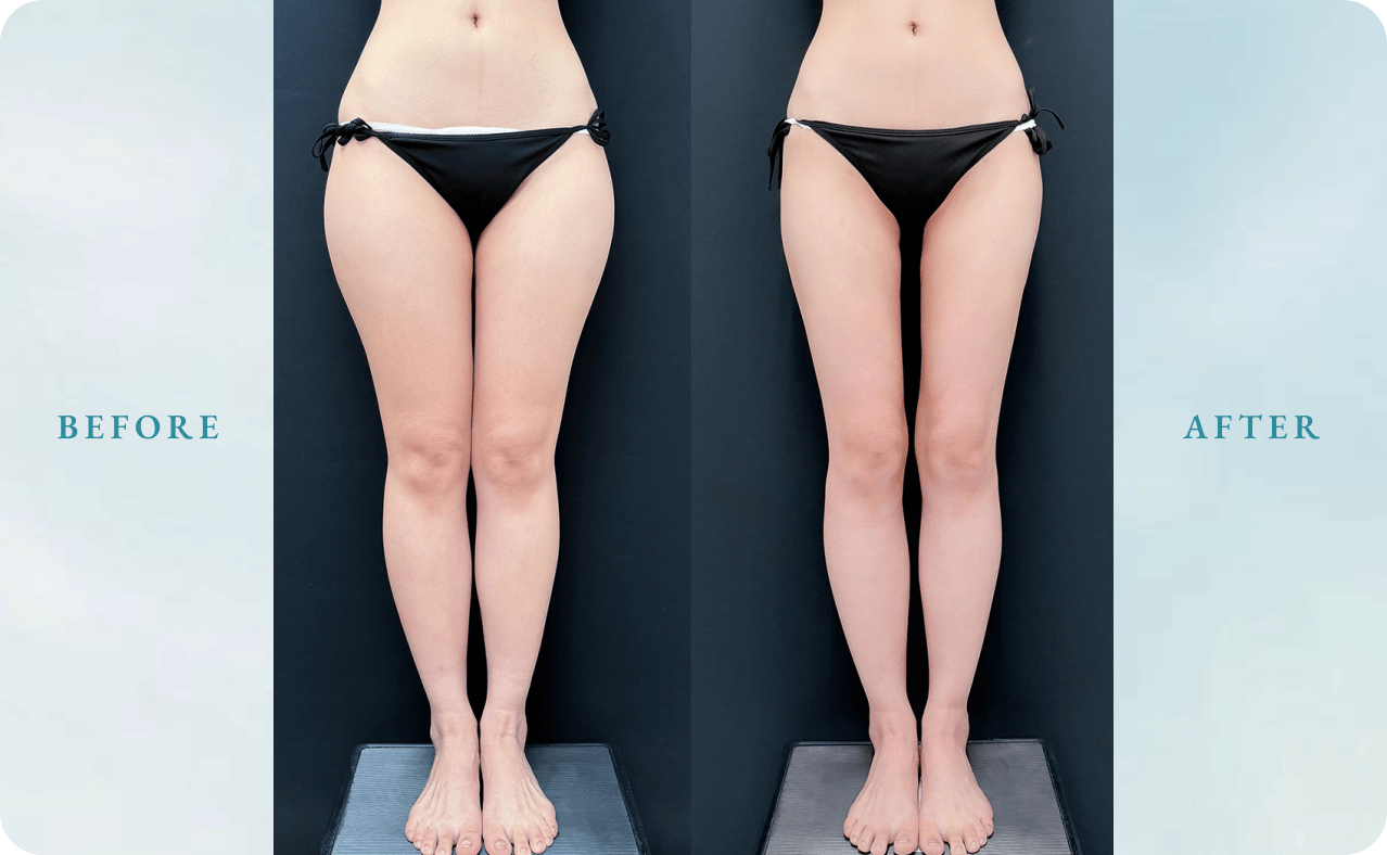 BeforeAfter画像