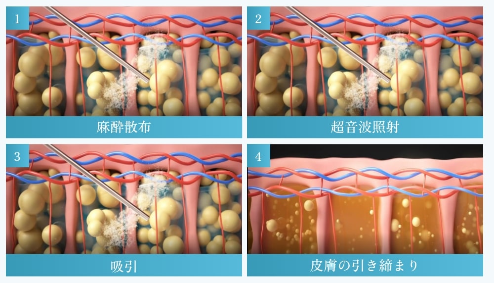 脂肪吸引の方法