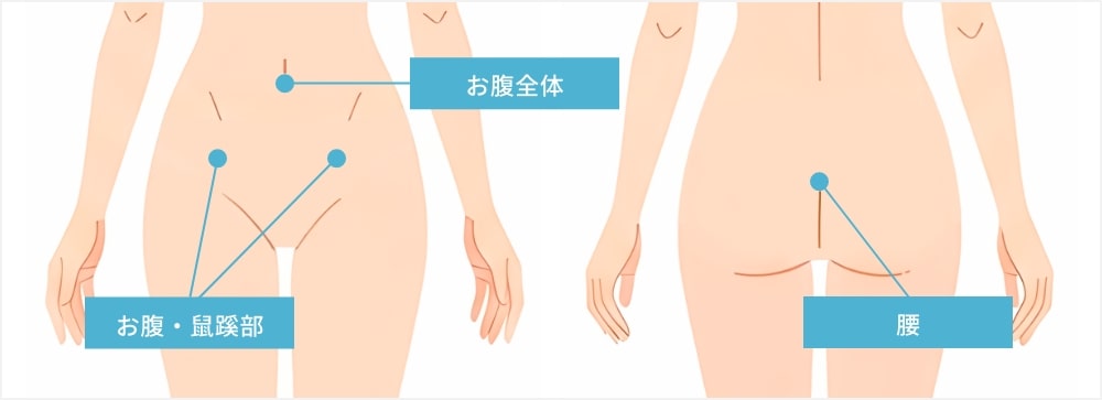 お腹脂肪吸引切開箇所