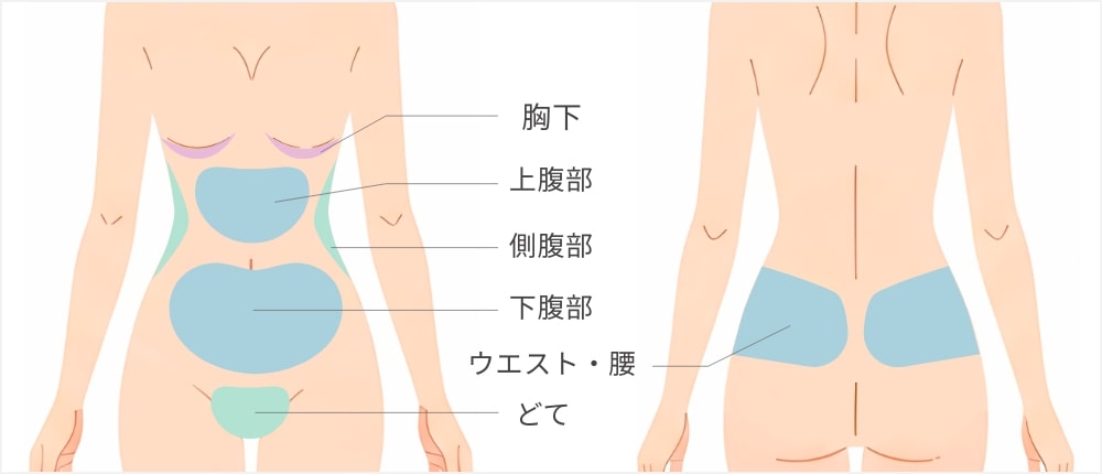 お腹・ウエスト・脂肪吸引脂肪吸引