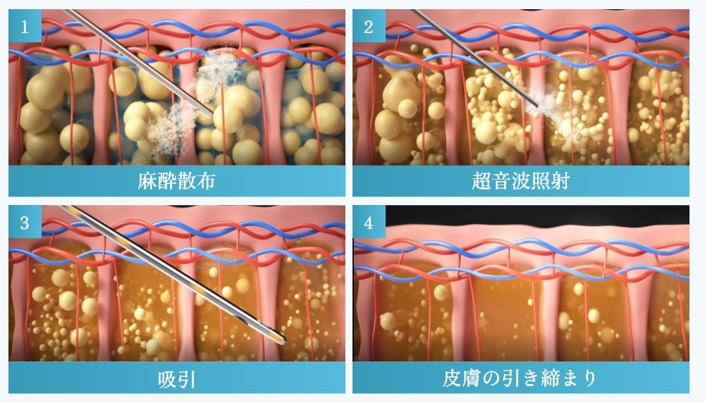 脂肪吸引の方法
