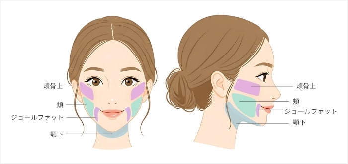 小顔脂肪吸引の施術部位