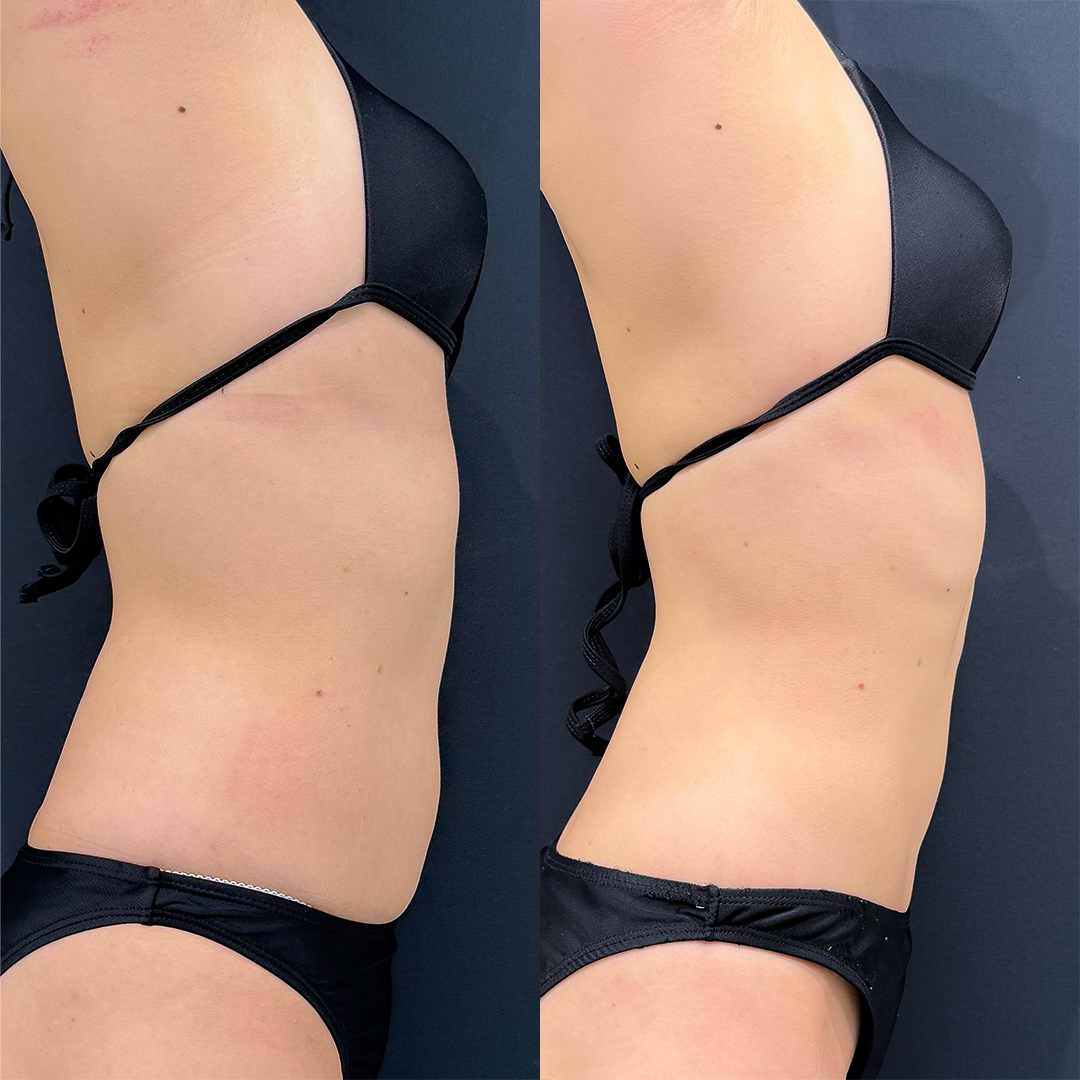 https://purelys-tokyo-clinic.com/wp/wp-content/uploads/2025/09/Before-and-After-abdominal-Liposuction_Case-No.24.jpg
