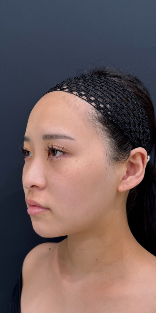 顔の脂肪吸引