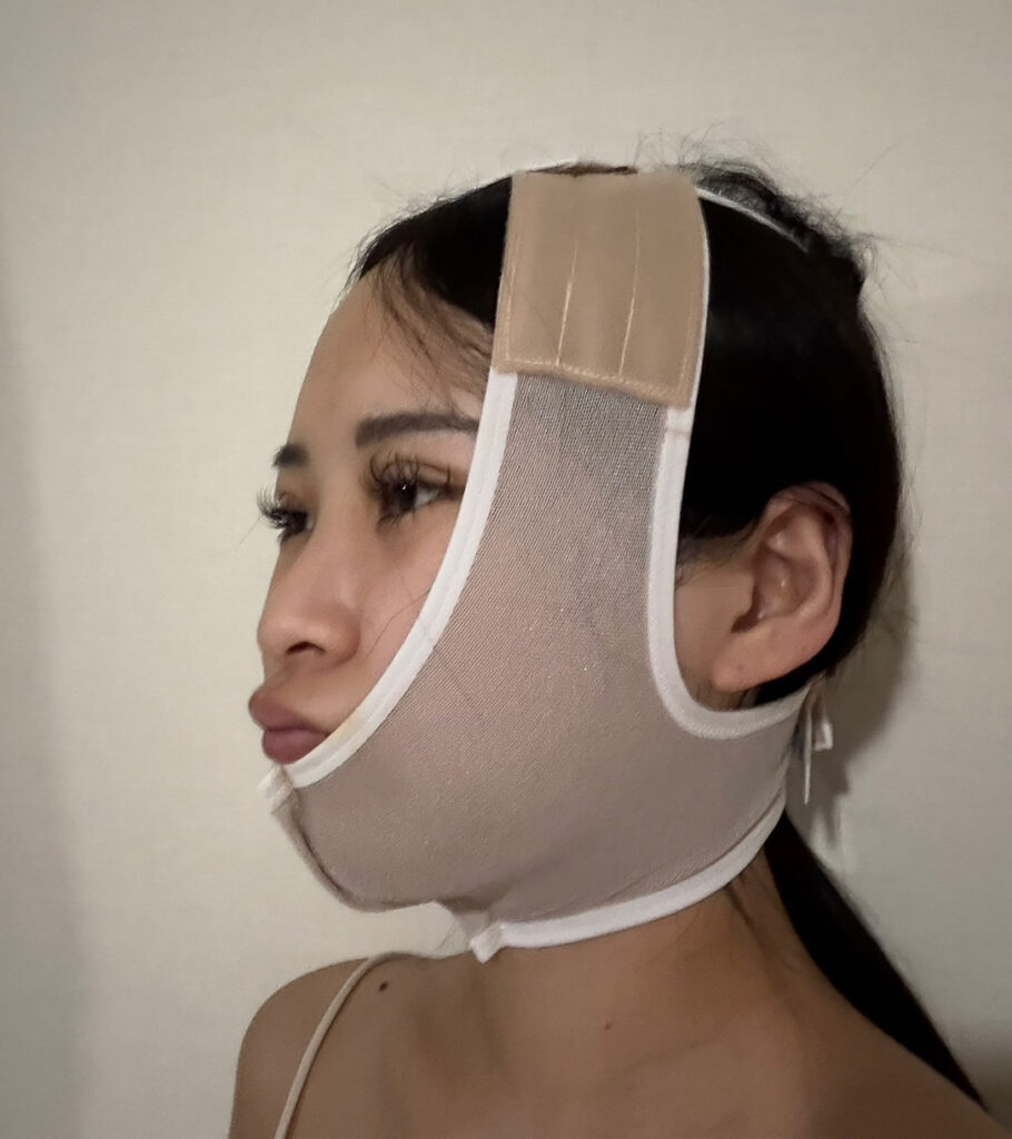 顔の脂肪吸引