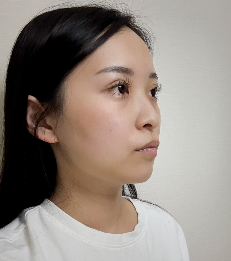 顔の脂肪吸引