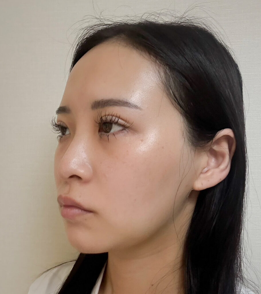顔の脂肪吸引