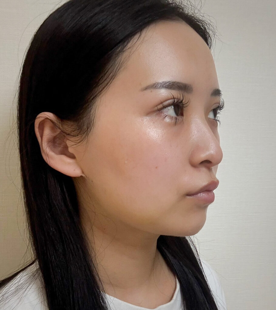 顔の脂肪吸引
