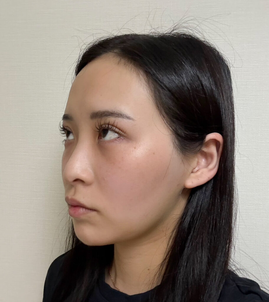 顔の脂肪吸引