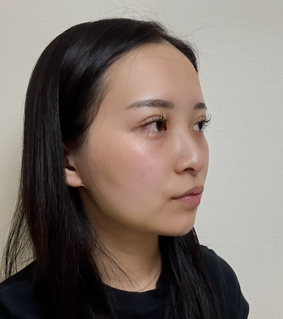 顔の脂肪吸引