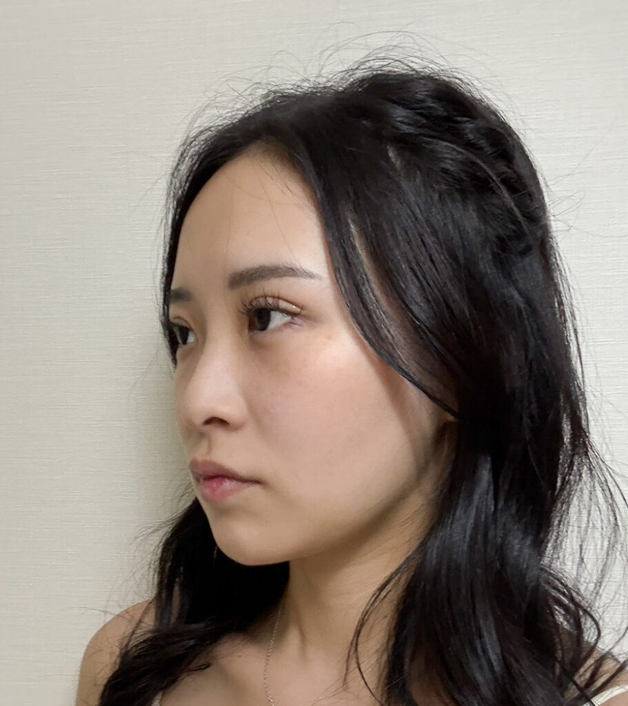 顔の脂肪吸引