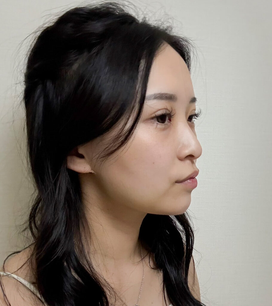 顔の脂肪吸引