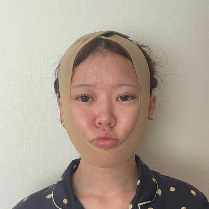 顔の脂肪吸引