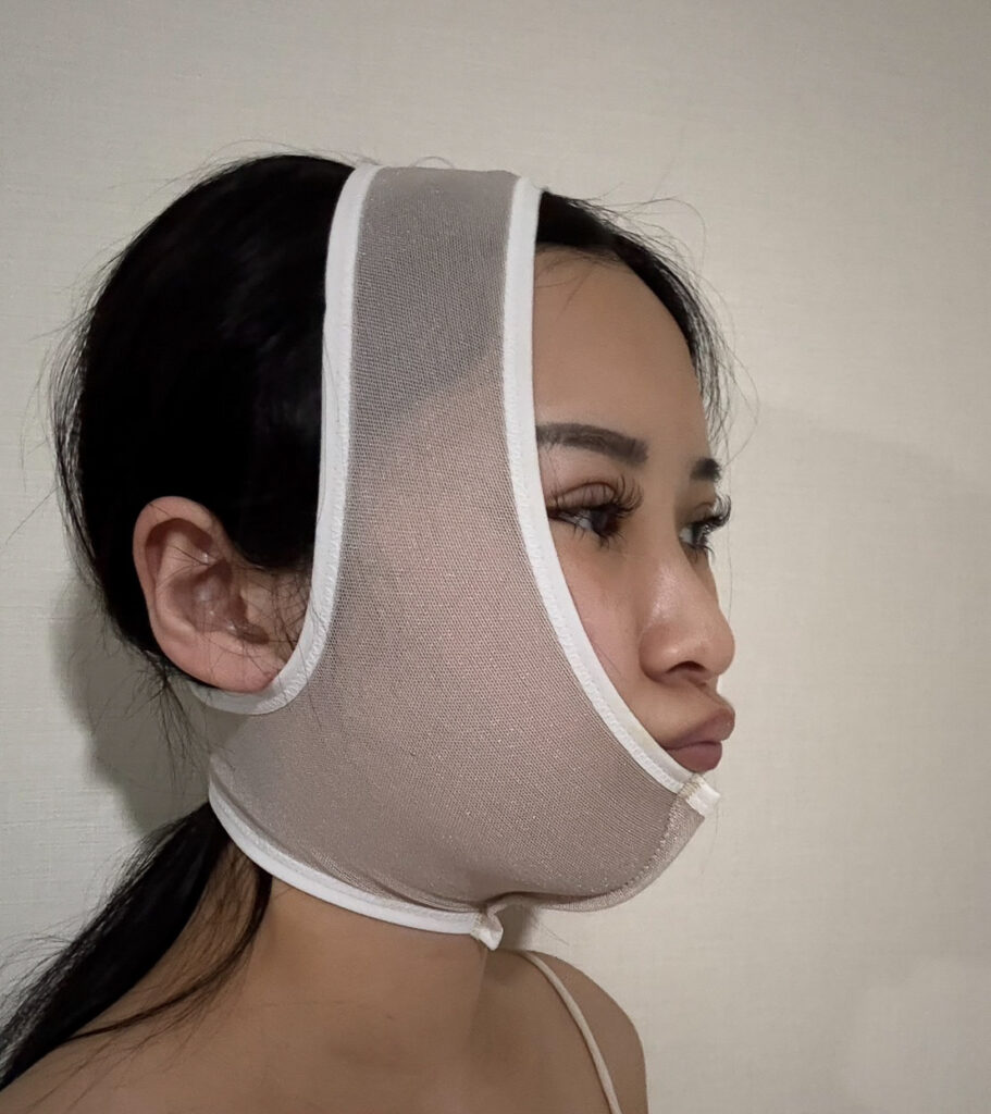 顔の脂肪吸引