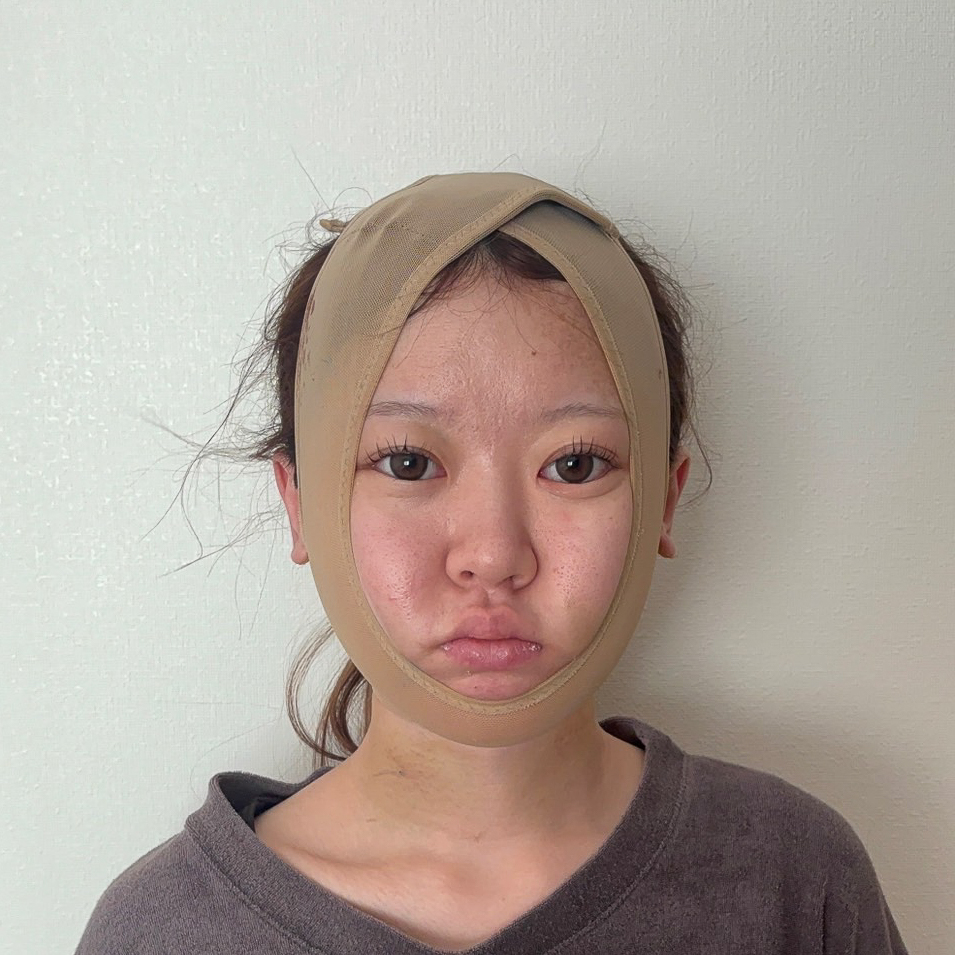 顔の脂肪吸引