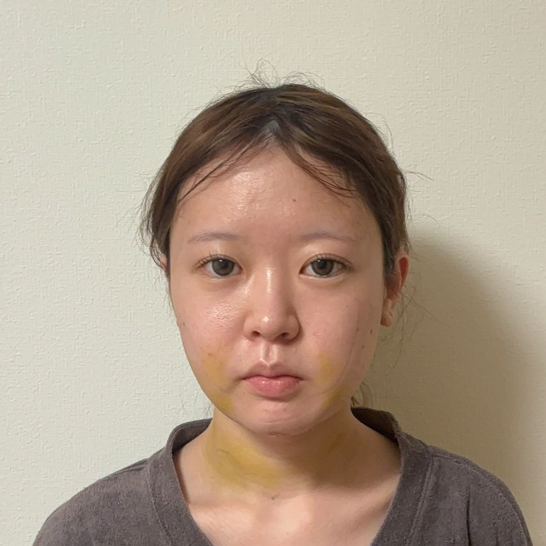 顔の脂肪吸引