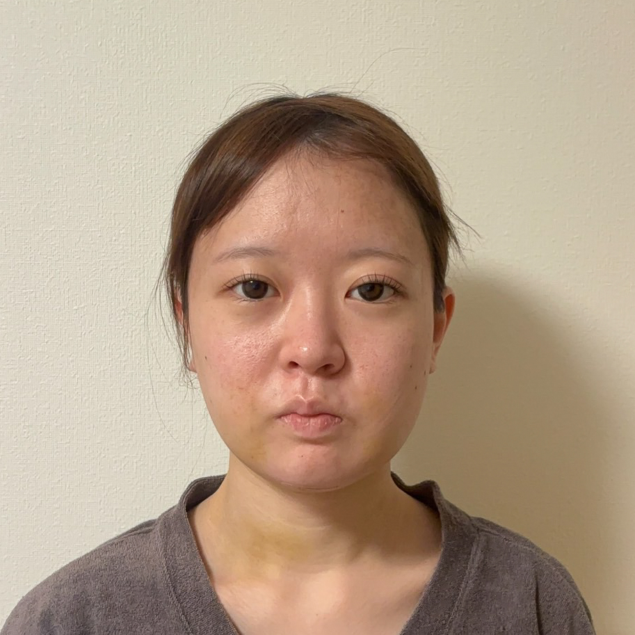 顔の脂肪吸引