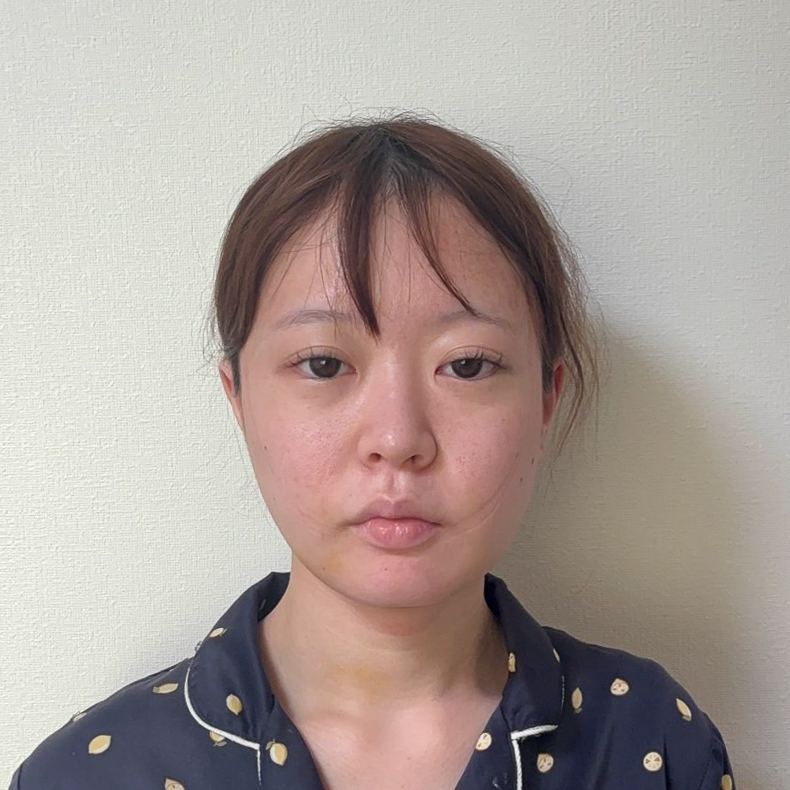 顔の脂肪吸引