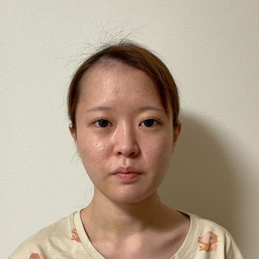 顔の脂肪吸引