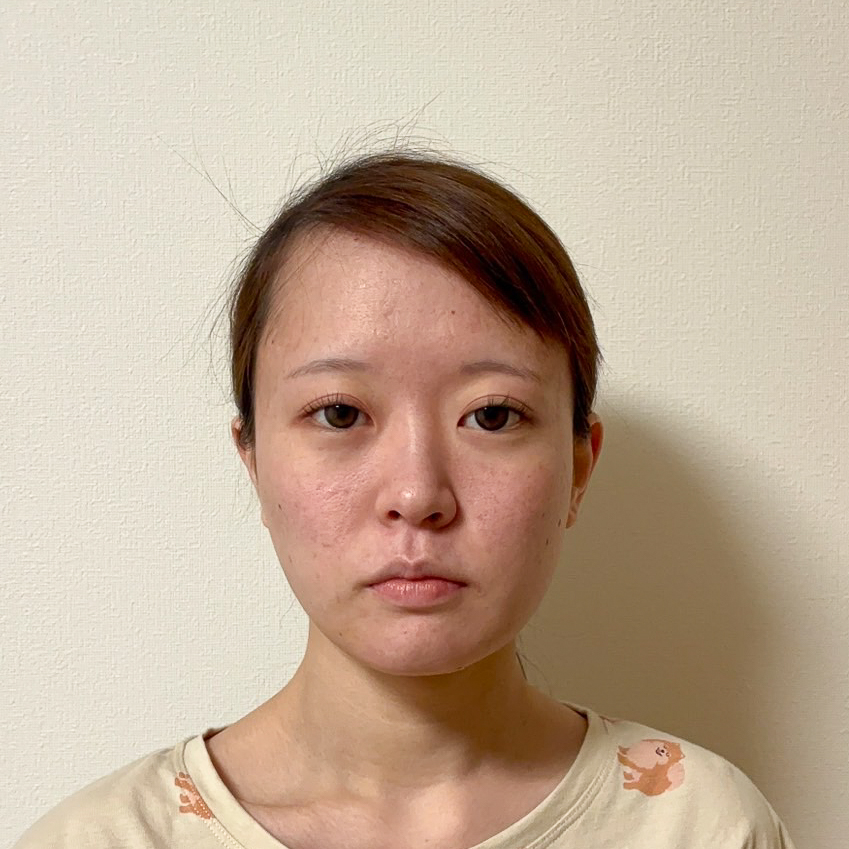 顔の脂肪吸引