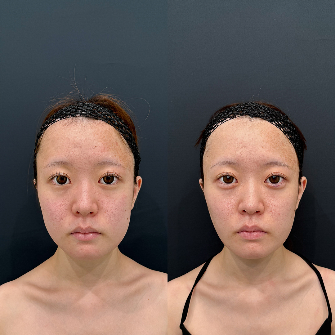 https://purelys-tokyo-clinic.com/wp/wp-content/uploads/2025/09/Before-and-After-face-Liposuction_Case-No.29.jpg