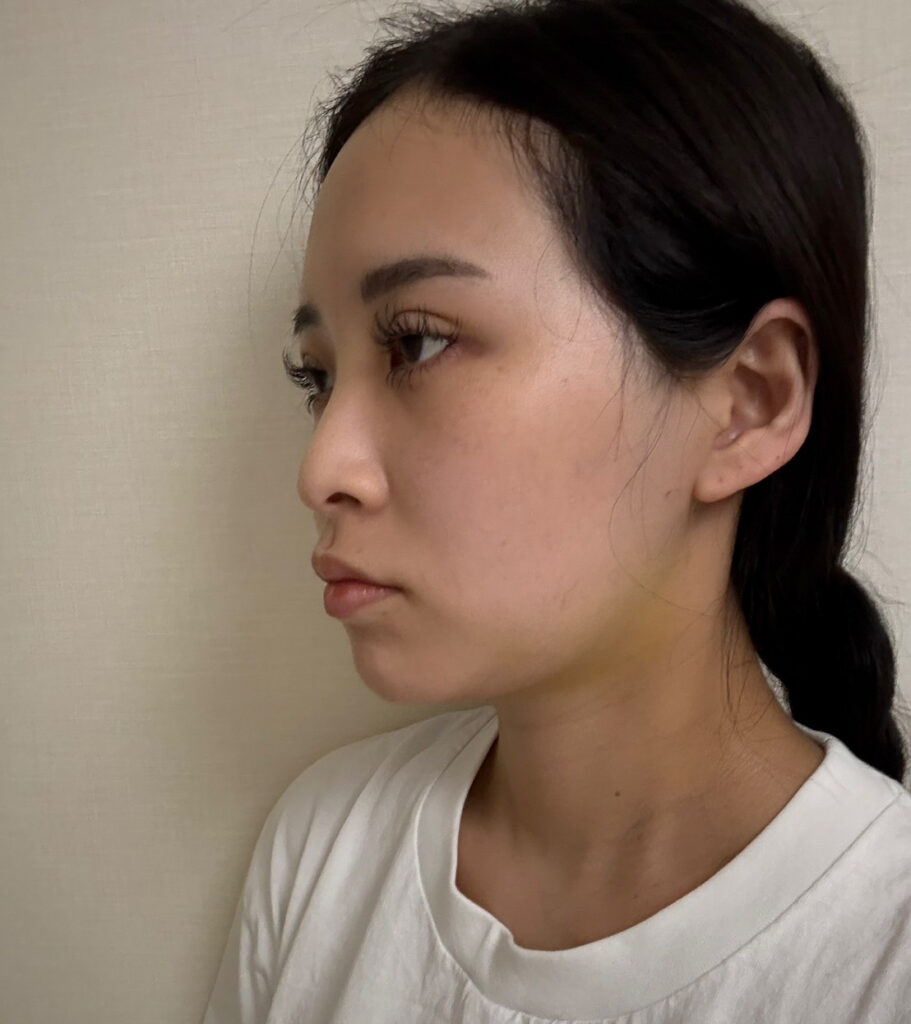 顔の脂肪吸引