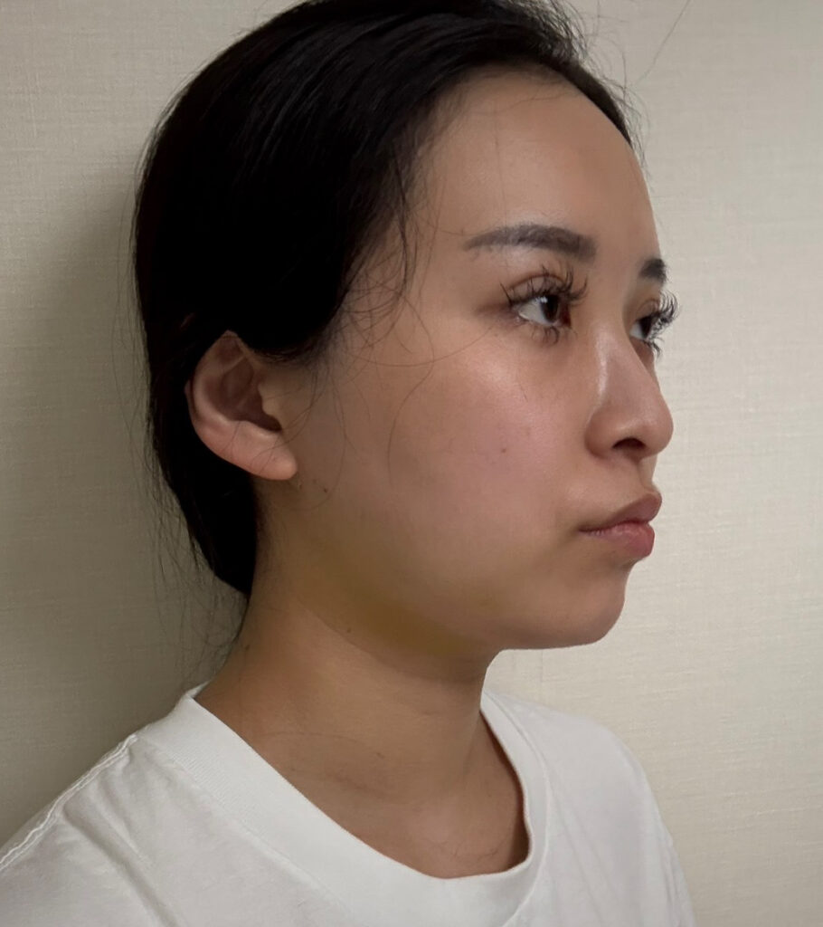 顔の脂肪吸引