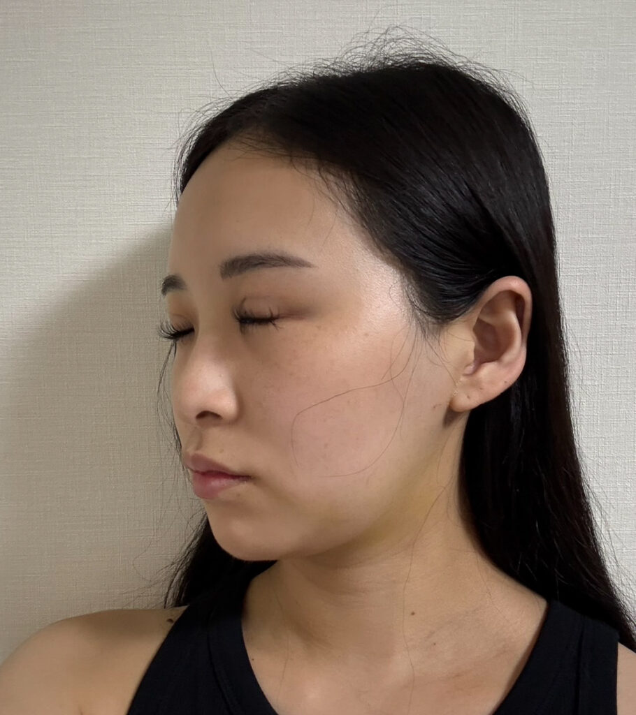 顔の脂肪吸引