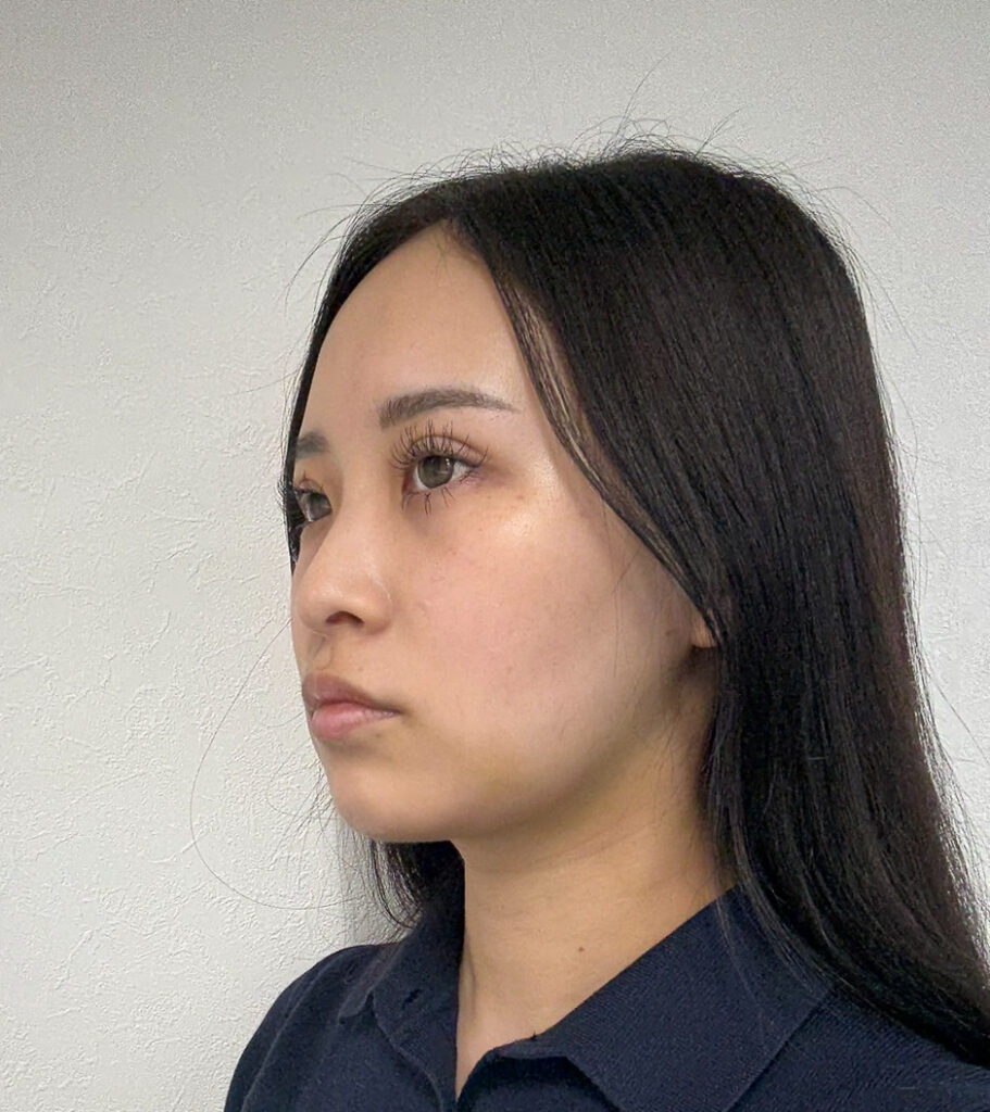 顔の脂肪吸引