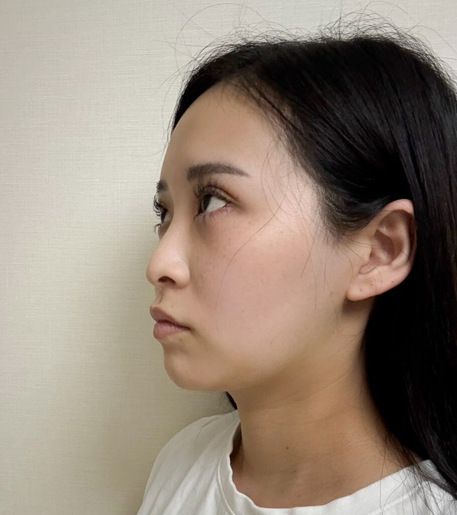 顔の脂肪吸引