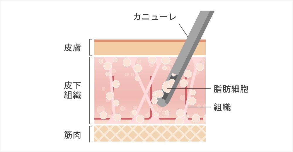 脂肪吸引のダウンタイム