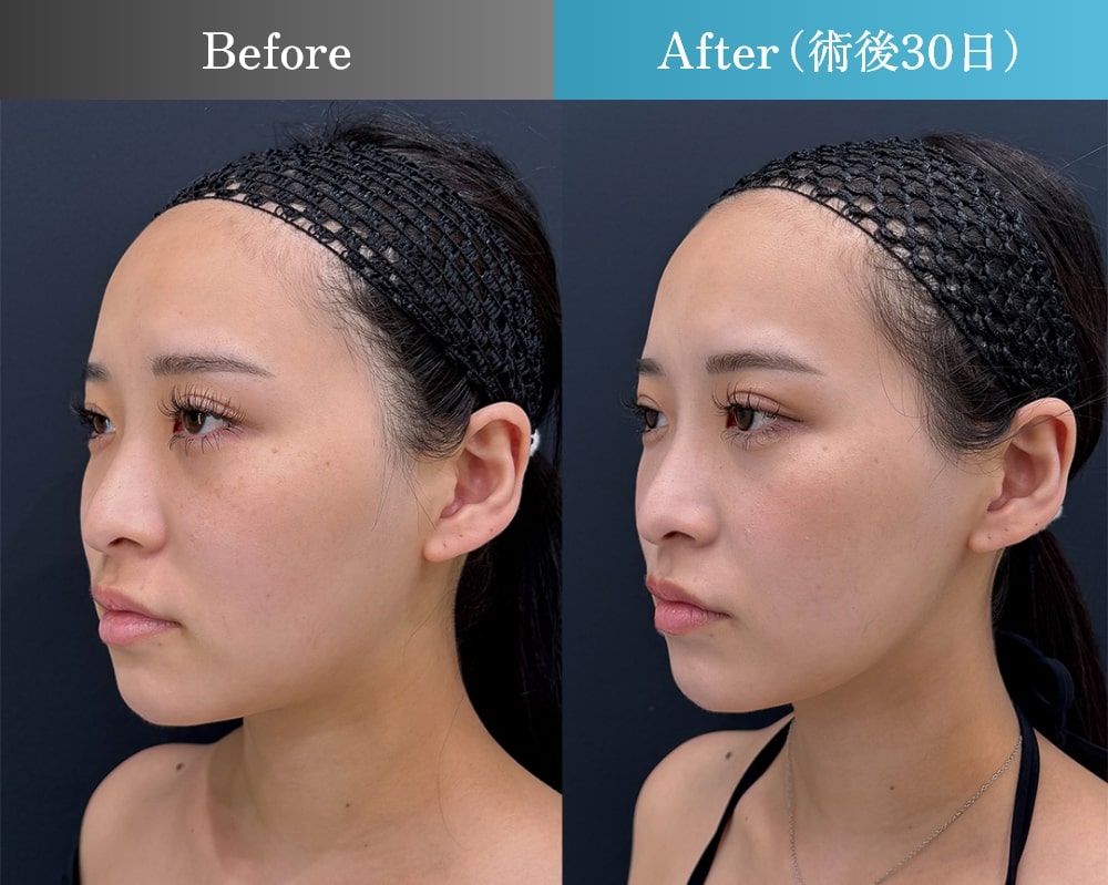 術後一か月の症例写真