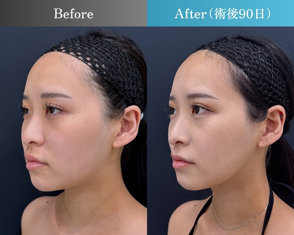 術後三か月の症例写真