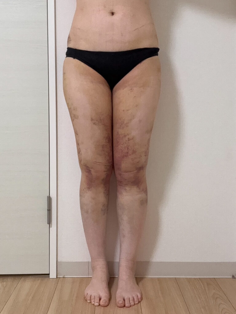 足の脂肪吸引