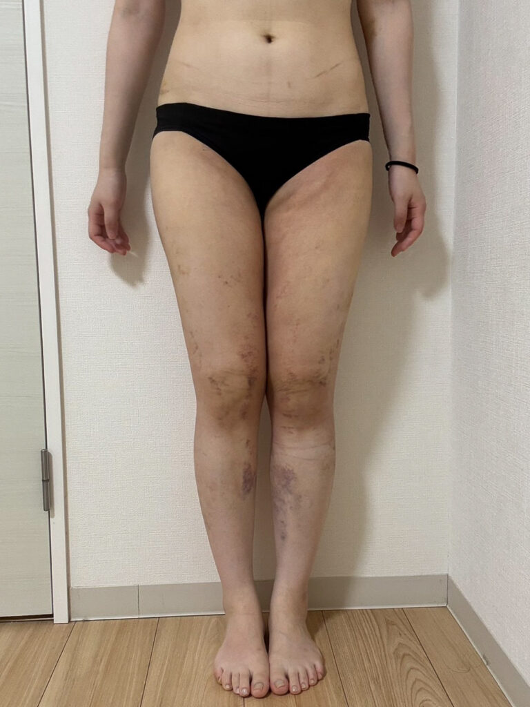 足の脂肪吸引