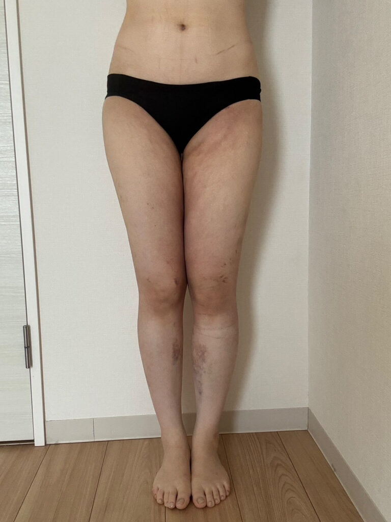 足の脂肪吸引