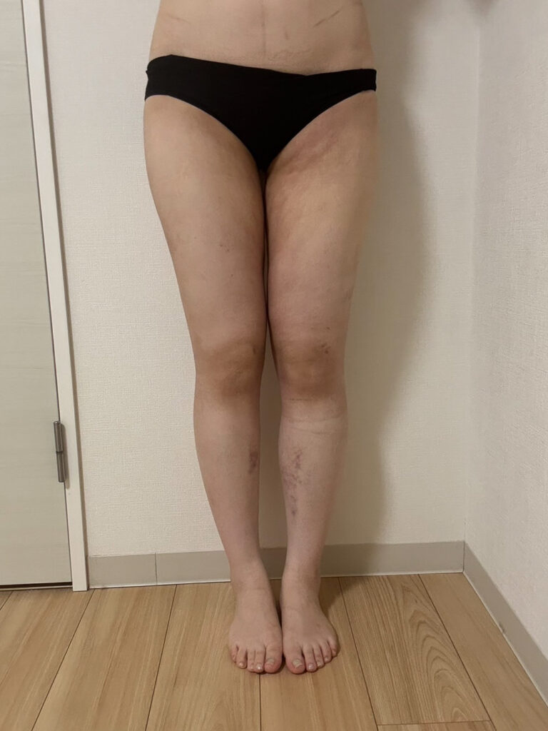 足の脂肪吸引