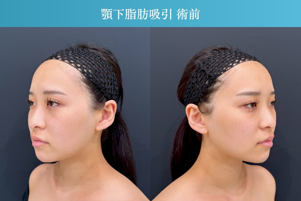 顎下脂肪吸引の術前