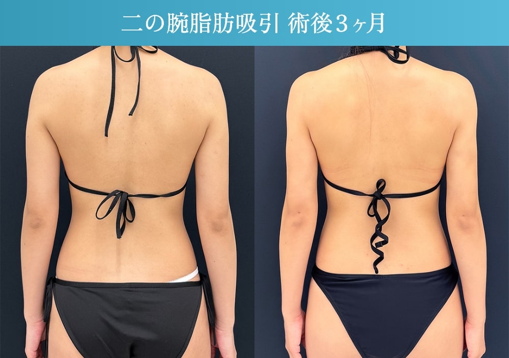 3か月経過写真01