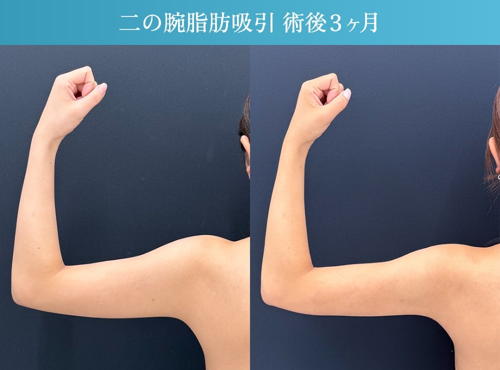 3か月経過写真01