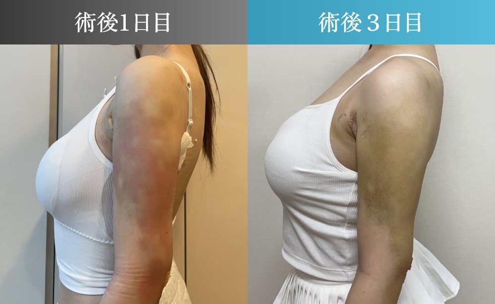二の腕脂肪吸引の術後1日目〜3日目