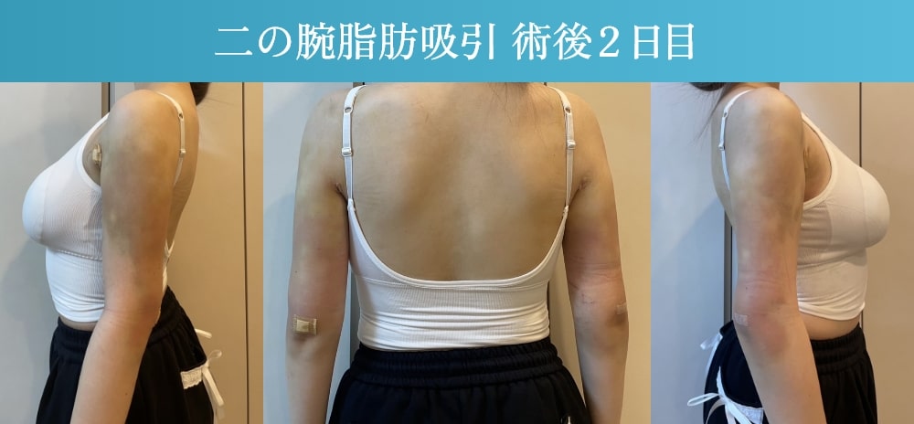 二の腕脂肪吸引