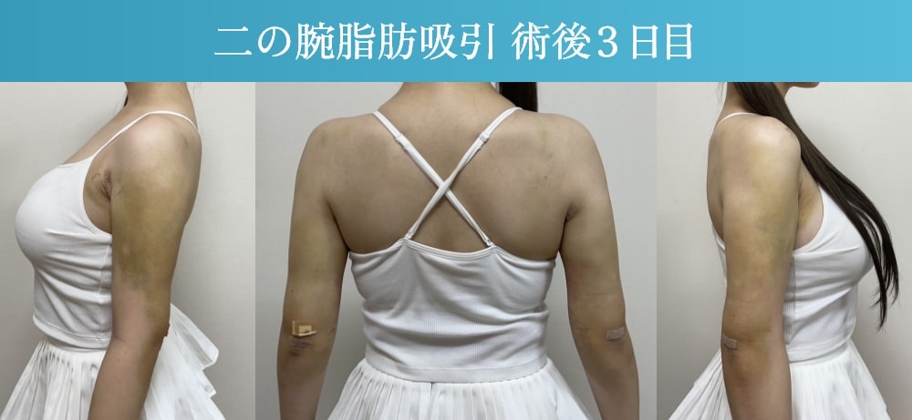 二の腕脂肪吸引
