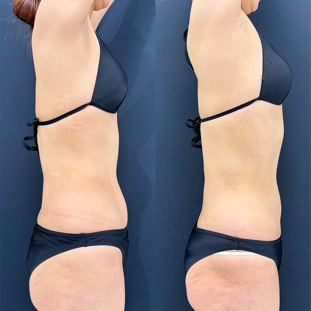 https://purelys-tokyo-clinic.com/wp/wp-content/uploads/2025/10/Before-and-After-abdominal-Liposuction_Case-No.41.jpg
