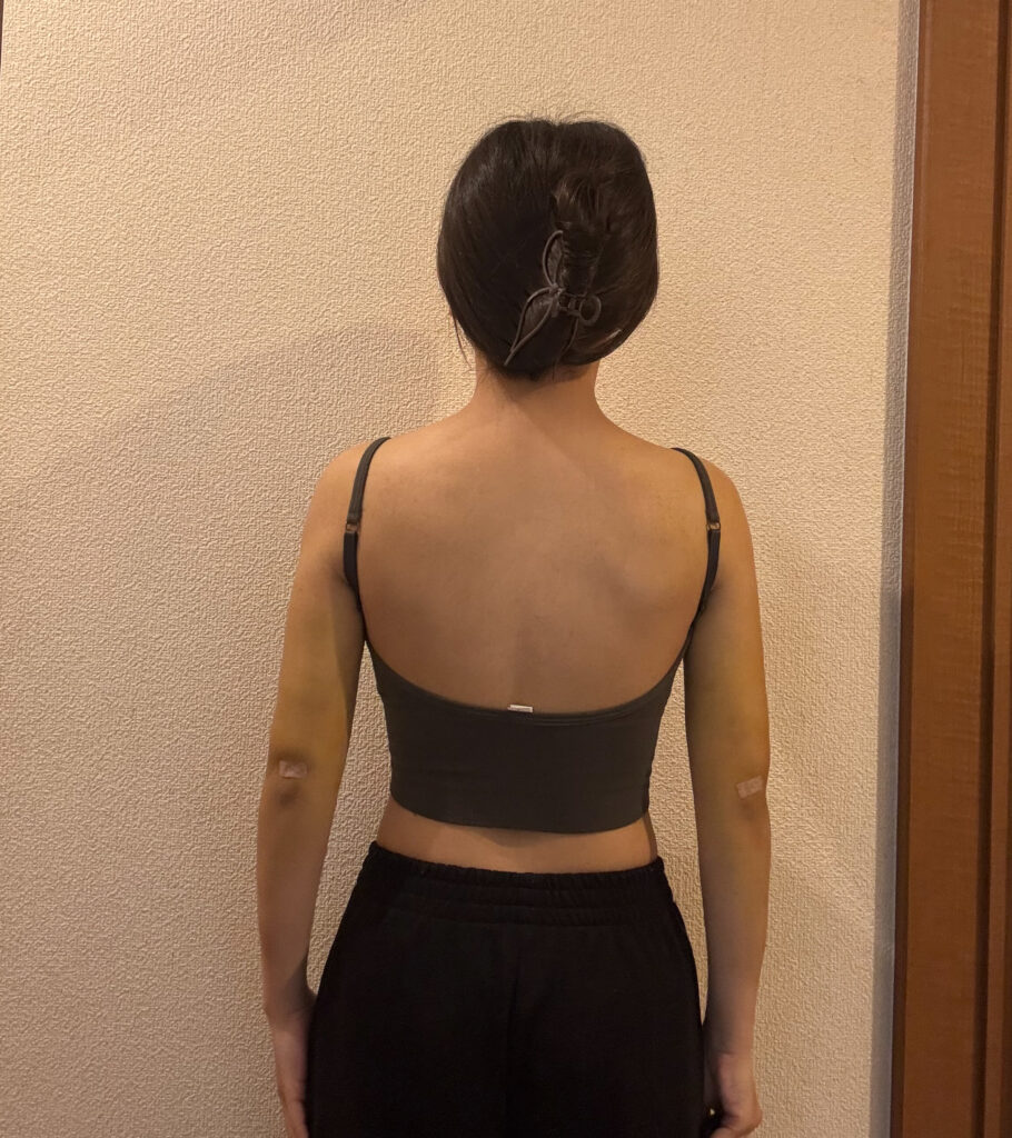 二の腕の脂肪吸引