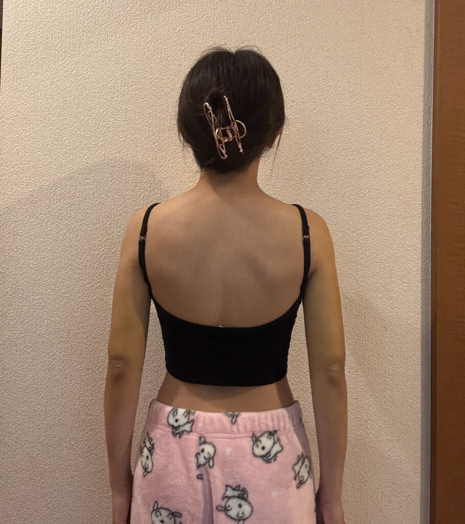 二の腕の脂肪吸引