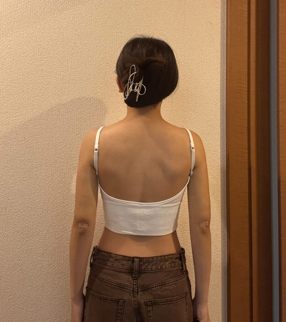 二の腕の脂肪吸引