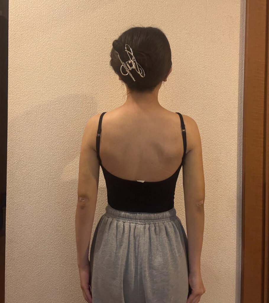 二の腕の脂肪吸引