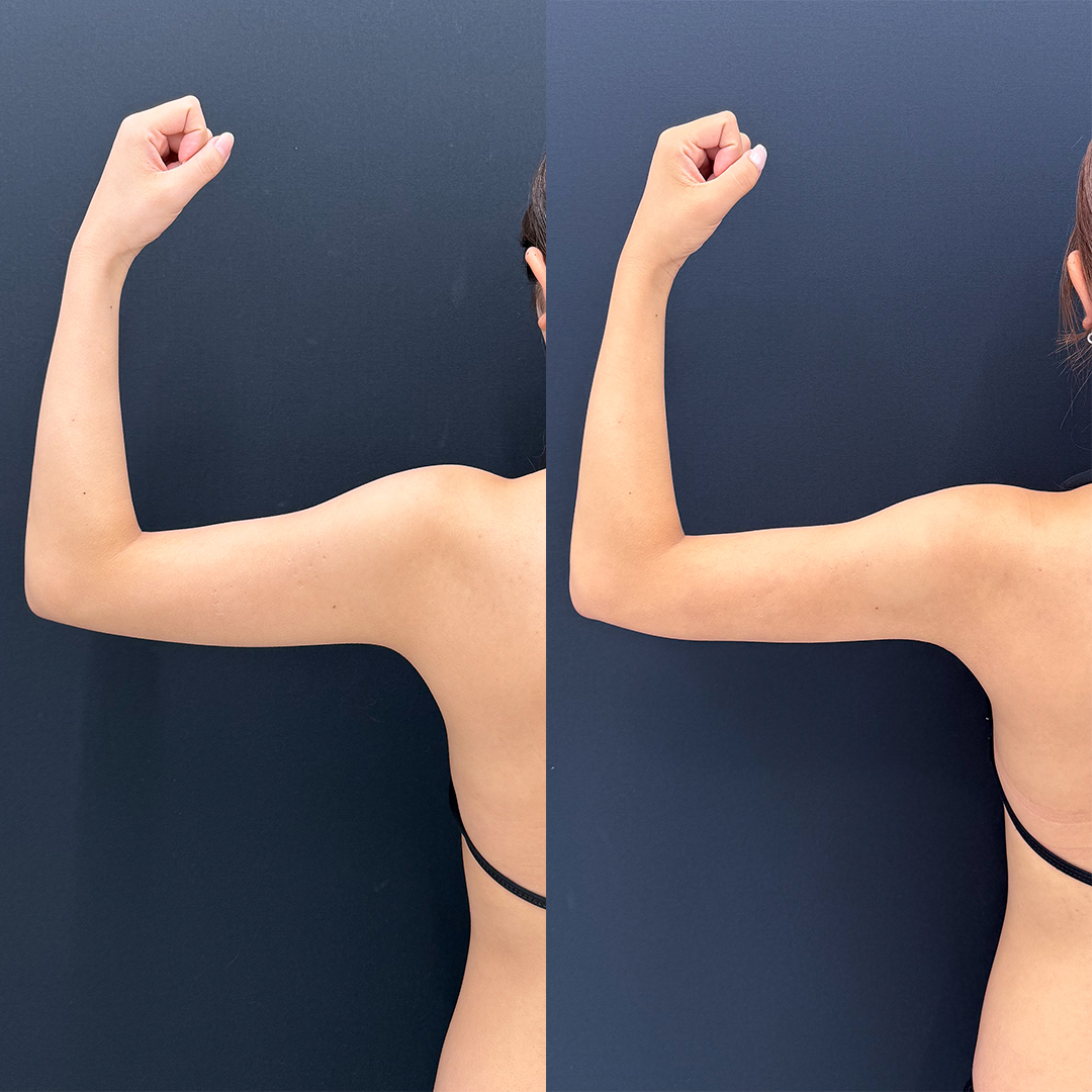 https://purelys-tokyo-clinic.com/wp/wp-content/uploads/2025/10/arm-Liposuction_Case-No.24.jpg