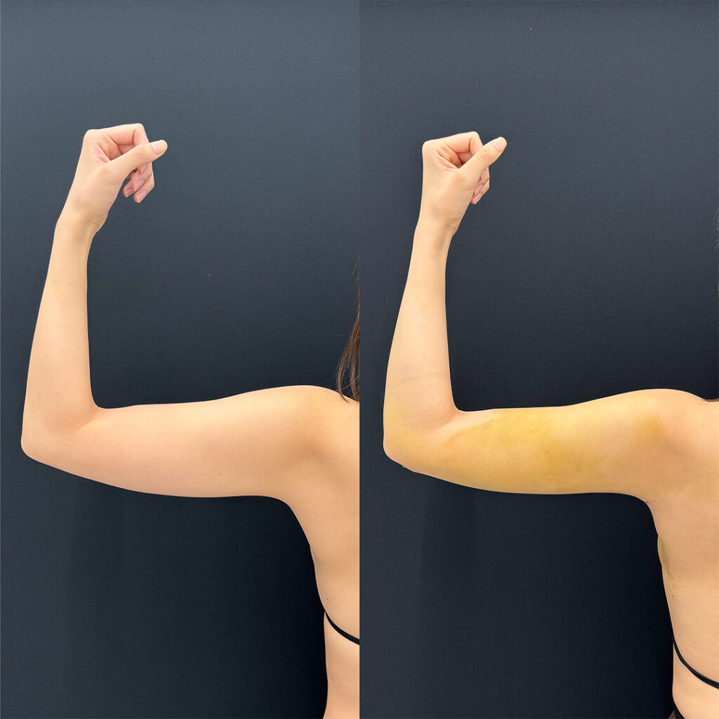 二の腕の脂肪吸引